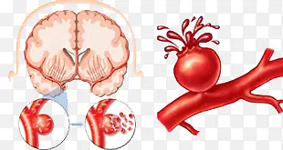 ��ͨ����Ѫ��-������