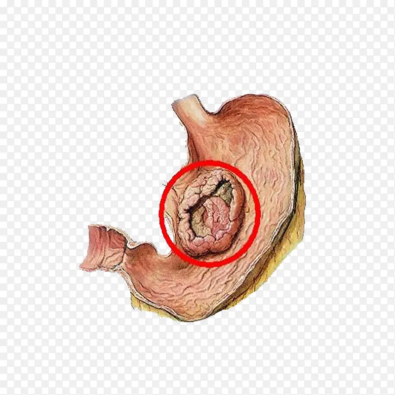 Ԥ����֢����-������