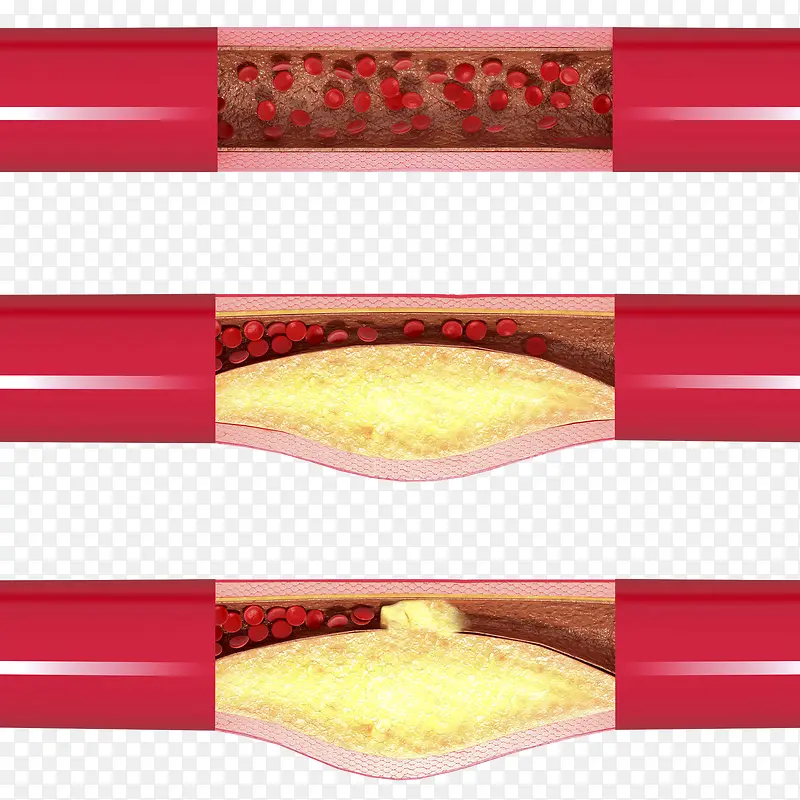 �Ķ���Ѫ�ܿ�ͨ�廭-������