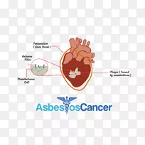 间皮瘤、癌症、石棉相关疾病、化疗.诊断和治疗-空若网 间皮瘤、癌症、石棉相关疾病、化疗.诊断和治疗-空若网