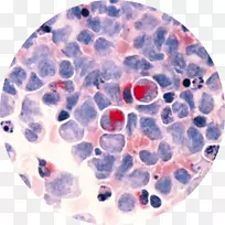 急性髓系白血病-空若网 急性髓系白血病-空若网