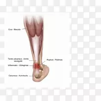跟腱炎跟腱阿基里斯跟腱-空若网 跟腱炎跟腱阿基里斯跟腱-空若网