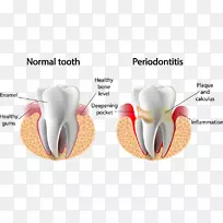 牙周病牙龈牙周病牙科学-健康-空若网 牙周病牙龈牙周病牙科学-健康-空若网