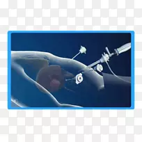 腹腔镜手术治疗癌症-?手术?-内镜下鼻内镜手术-空若网 腹腔镜手术治疗癌症-?手术?-内镜下鼻内镜手术-空若网