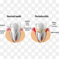 牙周病牙龈炎牙周病牙科学-健康-空若网 牙周病牙龈炎牙周病牙科学-健康-空若网