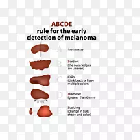 黑色素瘤皮肤癌基底细胞癌-空若网 黑色素瘤皮肤癌基底细胞癌-空若网