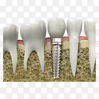 牙科种植牙外科种植牙图片材料-空若网 牙科种植牙外科种植牙图片材料-空若网