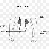 造口、尿转流、尿造口、囊袋系统-系统-空若网 造口、尿转流、尿造口、囊袋系统-系统-空若网