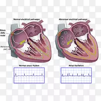 心律失常av结折返性心动过速房颤窦房结心房-心脏-空若网 心律失常av结折返性心动过速房颤窦房结心房-心脏-空若网