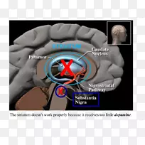 帕金森病物理治疗阿尔茨海默病-空若网 帕金森病物理治疗阿尔茨海默病-空若网