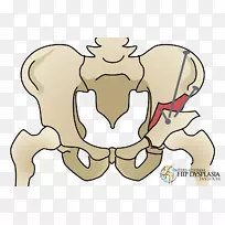 手指截骨髋关节发育不良手术-空若网 手指截骨髋关节发育不良手术-空若网