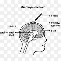 Ommaya水库鞘内注射化疗癌症脑瘤-空若网 Ommaya水库鞘内注射化疗癌症脑瘤-空若网