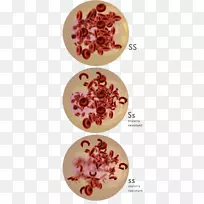共显性镰状细胞病遗传障碍遗传学红细胞溶解-空若网 共显性镰状细胞病遗传障碍遗传学红细胞溶解-空若网