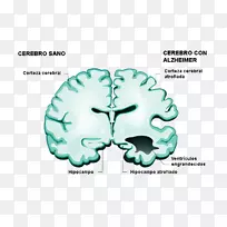 阿尔茨海默病脑膜炎图形人脑膜炎-空若网 阿尔茨海默病脑膜炎图形人脑膜炎-空若网
