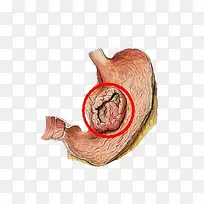 Ԥ����֢����-������